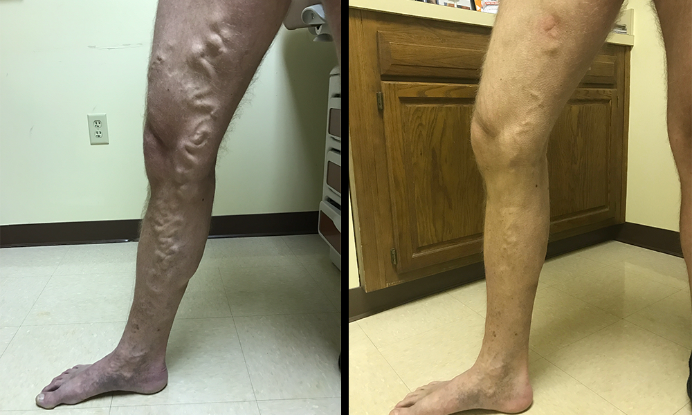 Vein-Before-After